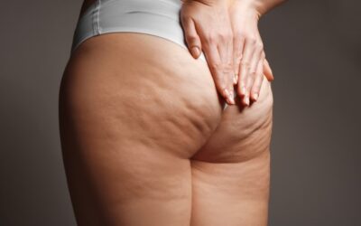 Endermologia na cellulit – cena, efekty, przeciwwskazania