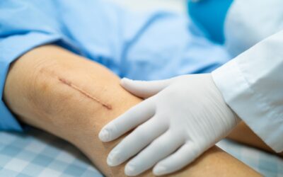 Domowe sposoby na blizny po operacji: Jak wspierać gojenie?