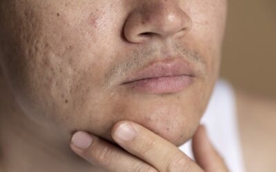 Domowe sposoby na blizny po trądziku: Co naprawdę działa na przebarwienia, a co jest stratą czasu?