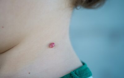 „Brodawki” na szyi: skąd się biorą i dlaczego nie wolno ich usuwać w domu?