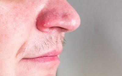 Domowe sposoby na czerwony nos: Dlaczego jest czerwony i jak go bezpiecznie uspokoić?