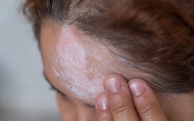 Domowe sposoby na łojotokowe zapalenie skóry: Jak opanować rumień i łuskę?