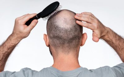 Domowe sposoby na łysienie plackowate – dlaczego to błąd i co naprawdę należy robić