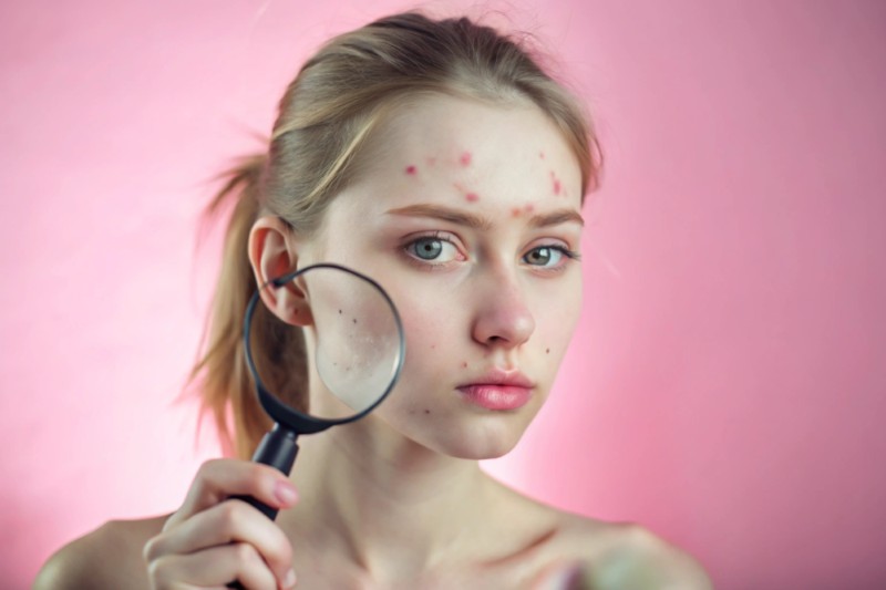 Jelita a trądzik: Oś jelita-mózg-skóra. Czy Twoja cera choruje przez to, co jesz?