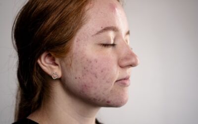 Trądzik bliznowaty (Acne Keloidalis): Gdy problem to nie pryszcze, a twarde guzy na karku
