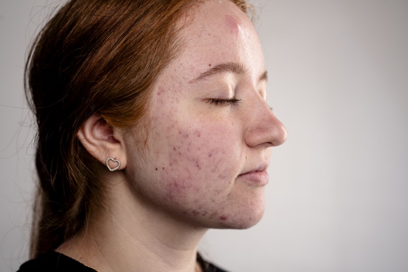 Trądzik bliznowaty (Acne Keloidalis): Gdy problem to nie pryszcze, a twarde guzy na karku