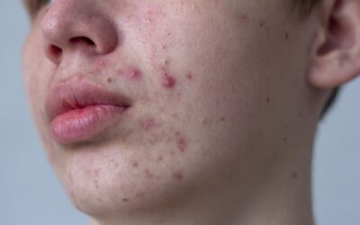 Trądzik grudkowo-krostkowy: Jak skutecznie leczyć zapalne zmiany i uniknąć przebarwień?