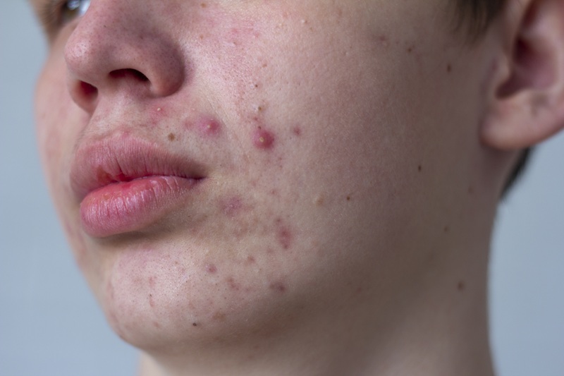 Trądzik grudkowo-krostkowy: Jak skutecznie leczyć zapalne zmiany i uniknąć przebarwień?
