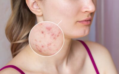 Trądzik grzybiczy (Fungal Acne): To wcale nie jest trądzik. Jak go rozpoznać i leczyć?