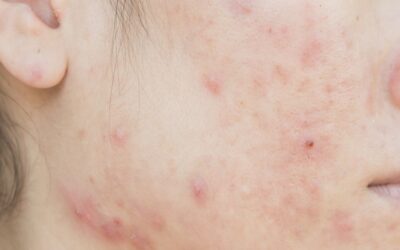 Trądzik: Choroba cywilizacyjna XXI wieku. Przyczyny, rodzaje i nowoczesne podejście do leczenia