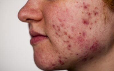Trądzik ropowiczy: Gdy cysty łączą się w ropnie. Najcięższa postać trądziku i walka z bliznami