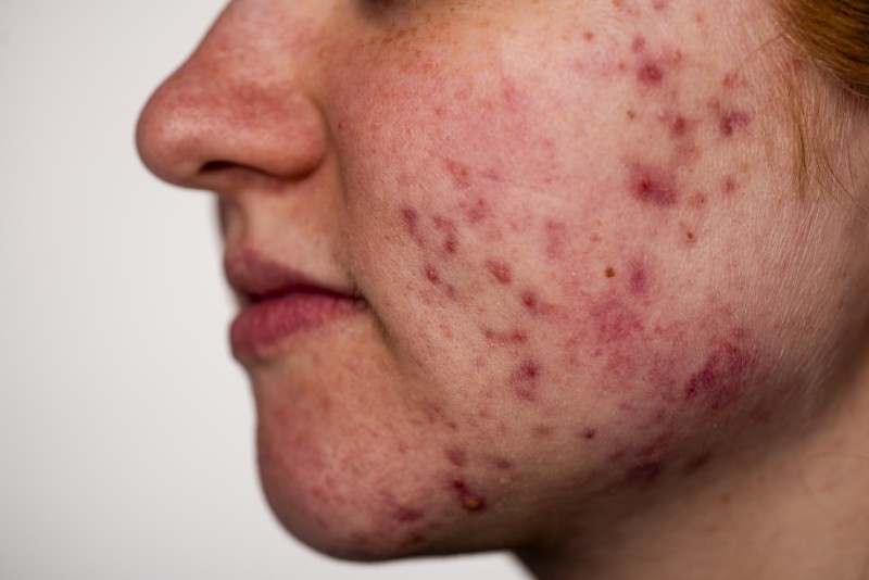 Trądzik ropowiczy: Gdy cysty łączą się w ropnie. Najcięższa postać trądziku i walka z bliznami