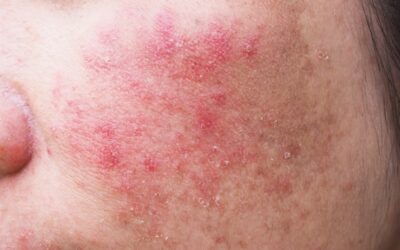 Trądzik różowaty (Rosacea): Kompendium wiedzy. Objawy, przyczyny i skuteczne leczenie „czerwonej twarzy”