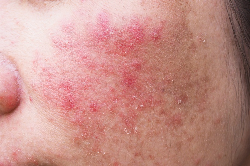 Trądzik różowaty (Rosacea): Kompendium wiedzy. Objawy, przyczyny i skuteczne leczenie „czerwonej twarzy”