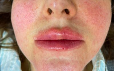 Jak wygląda trądzik różowaty? Zdjęcia i opis stadiów choroby. Nie pomyl go z alergią!