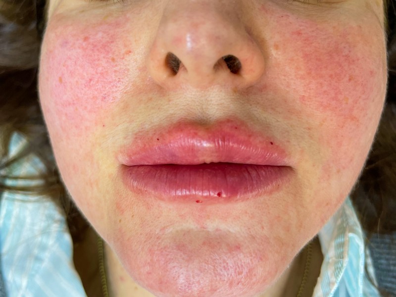 Jak wygląda trądzik różowaty? Zdjęcia i opis stadiów choroby. Nie pomyl go z alergią!