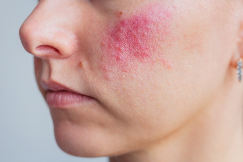 Trądzik różowaty